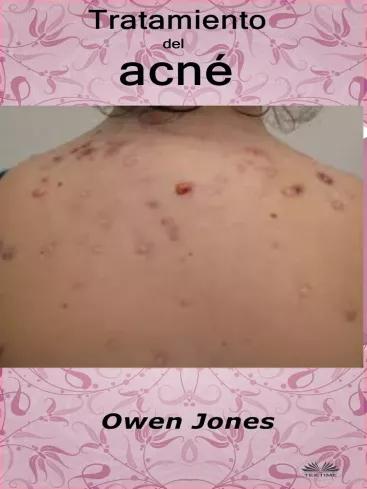 Tratamiento Del Acné (e-könyv)